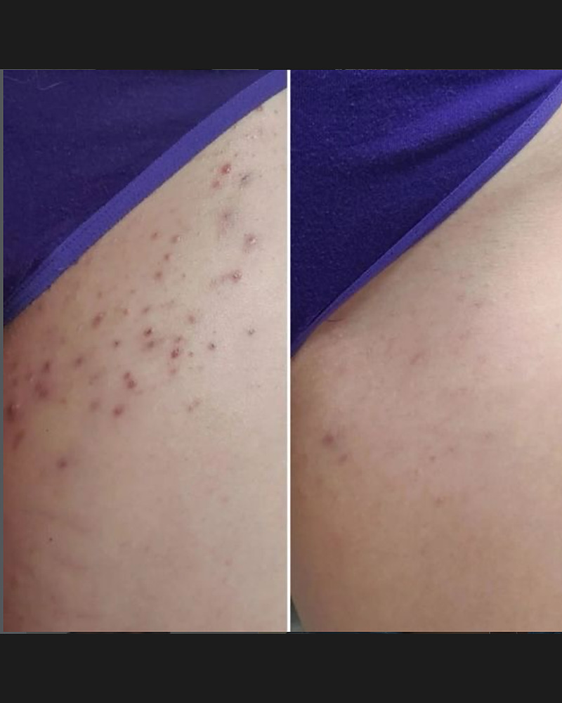 Laser hair removal before and after for ingrown hairs and razor bumps at J Artistry Clinic in Coventry