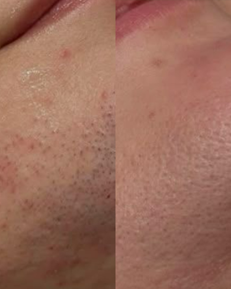 Laser hair removal before and after for pcos facial hair at J Artistry Clinic in Coventry